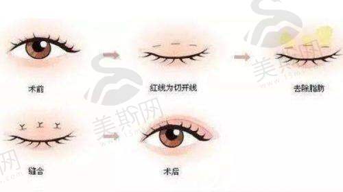 3、重庆双眼皮医生排名第三——姜宇禄
