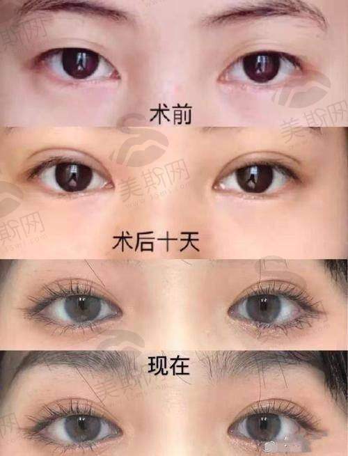 2、重庆双眼皮医生排名第二——樊东力