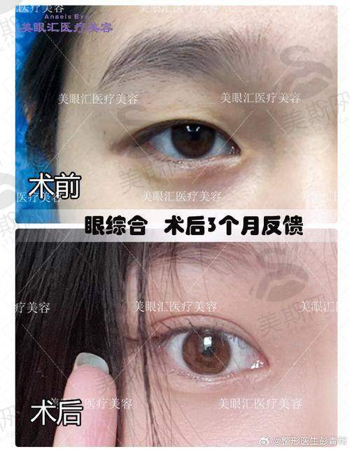 5、重庆双眼皮医生排名第五——单磊