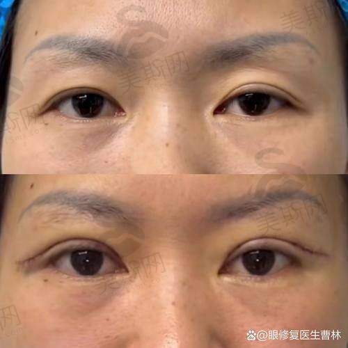 理性提醒：双眼皮修复没有“理想解”，但好的面诊能让你“少走3年弯路”
