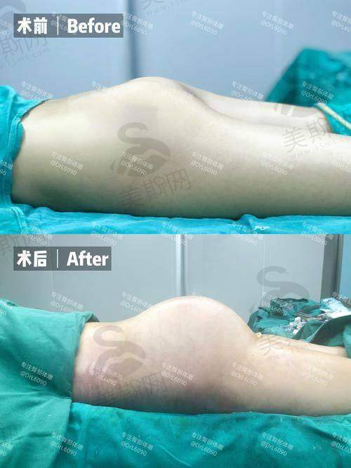 胶原绷带3.0正确打开方式：这样用，成效多维持2个月