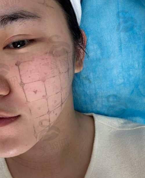 薇旖美胶原蛋白注射后:这些事比价格更重要!