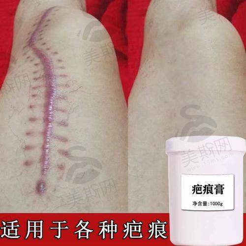 二、重庆疤痕修复项目深度解析
