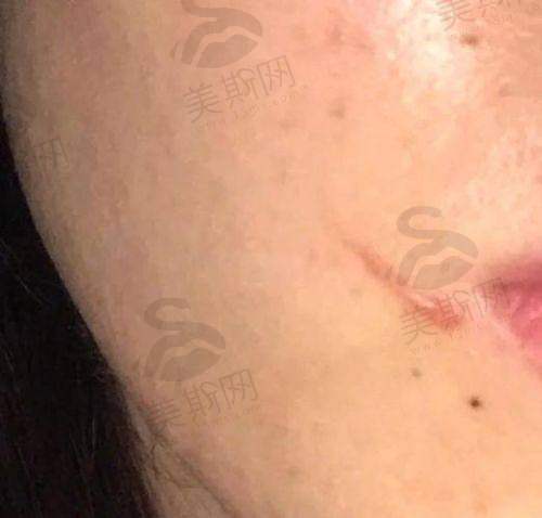 实例三：剖腹产疤痕修复，1.8万元告别