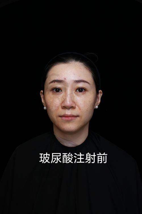 百映妍打针常见误区:间隔太短或太长有什么危害?