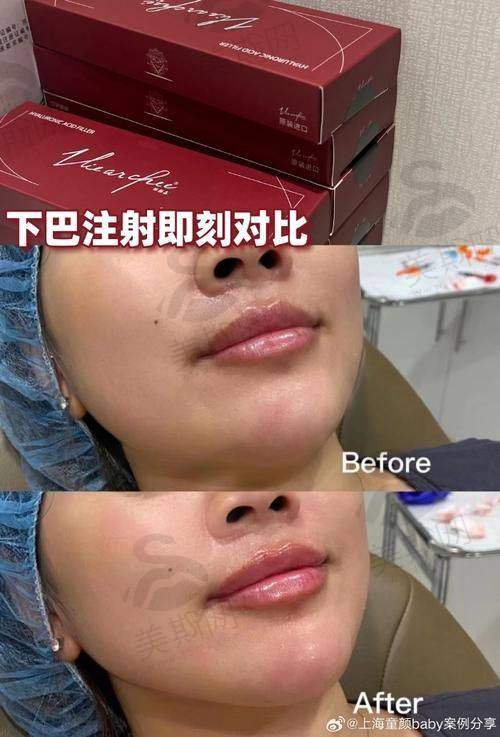百映妍至佳打针间隔时间:为什么急救期要每月1次?