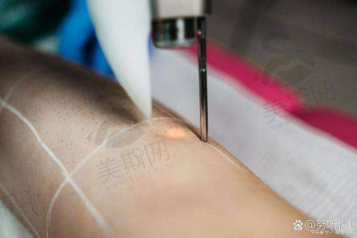 苏大附一院激光脱毛成效揭秘
