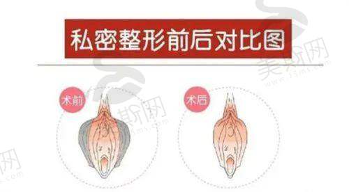 阴道紧缩针相关补充