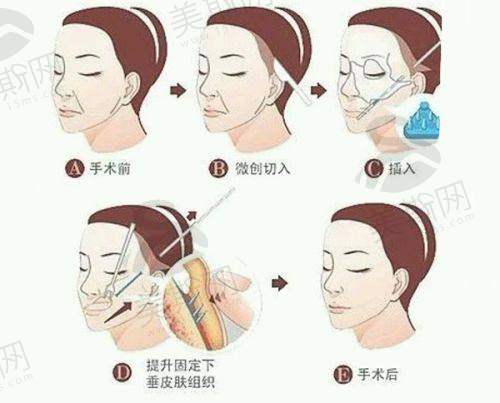 北京做鼻子价格参考