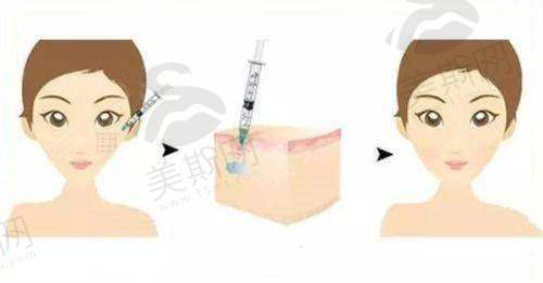 骨水泥颅顶填充术价格表