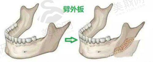 骨水泥颅顶填充术前后对比
