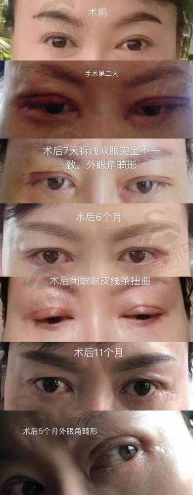 上海美诗沁去眼袋成效好吗？核心技术为何能做到“去得干净不复发”？