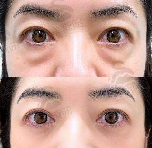 【上海美诗沁去眼袋效果好吗】2025真实测评：不开刀技术靠谱|去得干净不易复发|宣瑞军医生口碑赞！