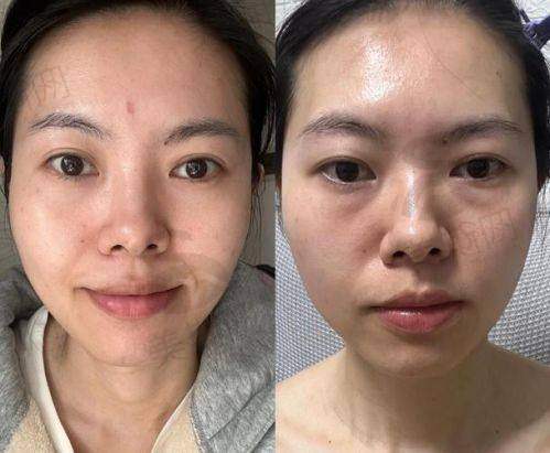 总结：上海美诗沁去眼袋成效好吗？真实答案+预约攻略