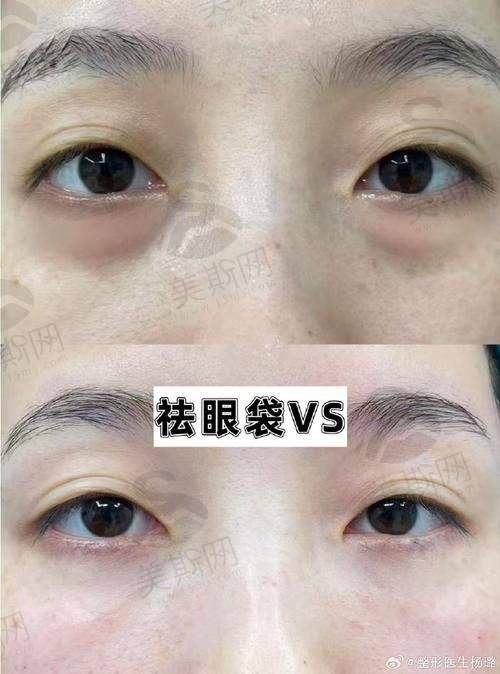 上海美诗沁去眼袋成效好吗？哪些人不适合做？避坑指南请收好！