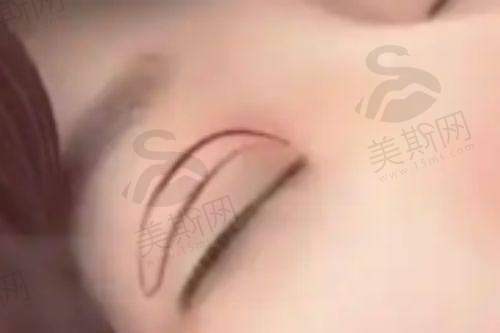 沈阳假体隆胸手术价格信息