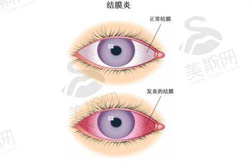 实例2:上班族王女士(800度近视 + 散光200度)