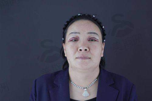 成都军大整形美容医院收费价目表之鼻部整形:假体/自体软骨价格与成效保护