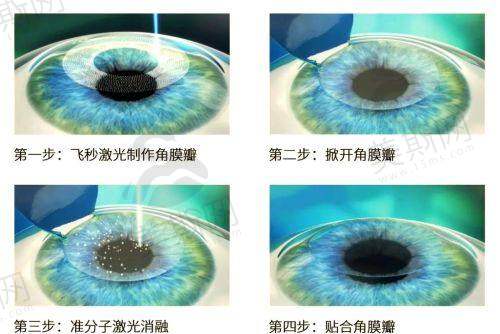 二、重庆佰视佳眼科医院赵小虎 半飛秒主刀医生团队介绍