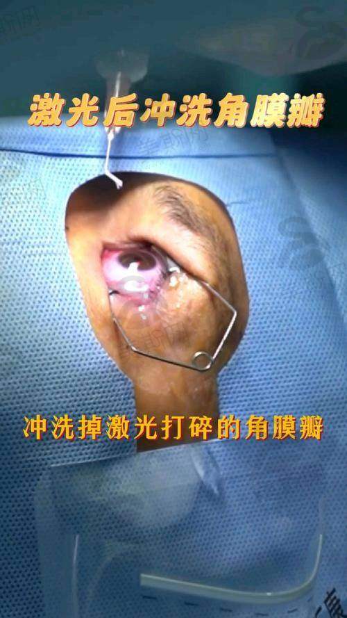 四、重庆佰视佳眼科赵小虎全飞秒15000元起真实实例:三位患者的“摘镜日记”