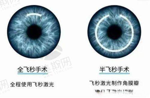 四、重庆佰视佳眼科赵小虎半飞秒1000元起 真实口碑实例