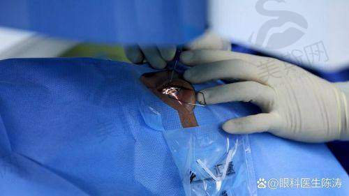 四、重庆佰视佳眼科赵小虎个性化半飞秒12000元起真实实例:3位患者亲述修复成效