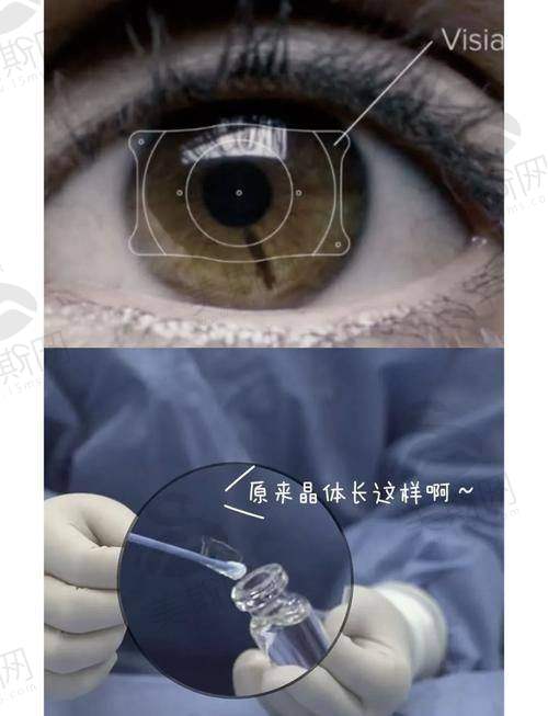 二、重庆佰视佳眼科医院赵小虎T - ICL晶体植入30500元起 主刀医生团队介绍