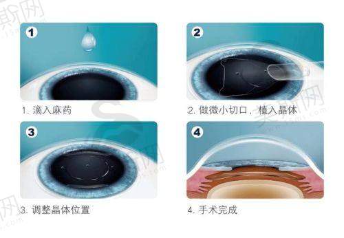 重庆佰视佳眼科赵小虎T-ICL晶体植入30500元起，高清可逆适应高度近视术后视觉更清晰