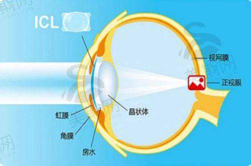 3.4 项目操作流程：4步完成，手术仅需10分钟