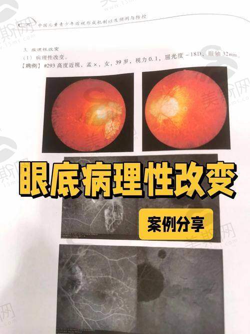 北京希玛林顺潮眼科医院术前术后避坑指南