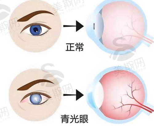 二、重庆佰视佳眼科医院赵小虎全飞秒主刀医生团队:技术与口碑双保护