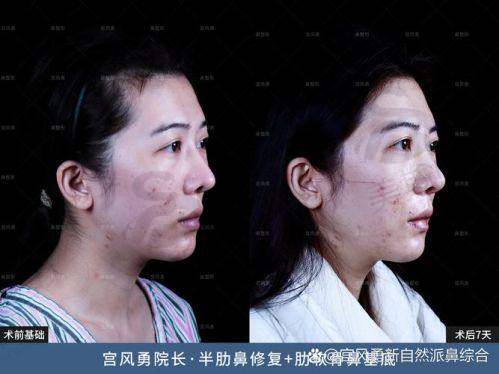 六、理性提醒:医美不是买菜,低价背后要注意什么?