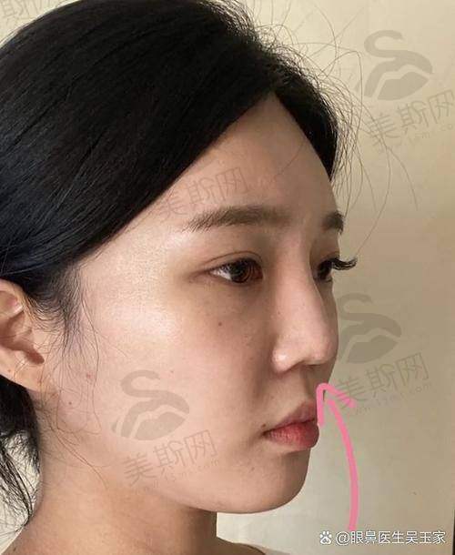 上海排名前十隆鼻医生大揭秘