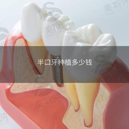 真相2：深圳種牙平咁多，質素有冇保證？