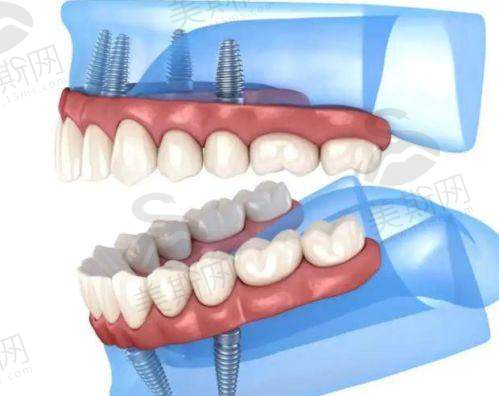 種植牙品牌2025邊款抵？香港西九高鐵20分鐘到深圳種牙2980起
