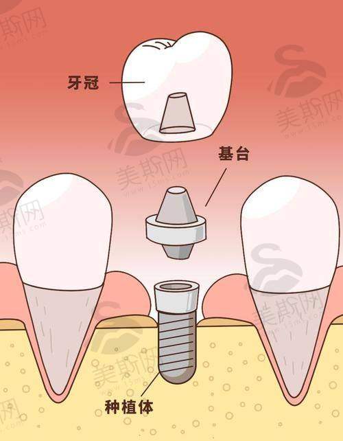 理性提醒：種牙係「長期投資」，唔好貪平亂揀