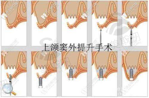 術後:呢啲「護理細節」決定成敗