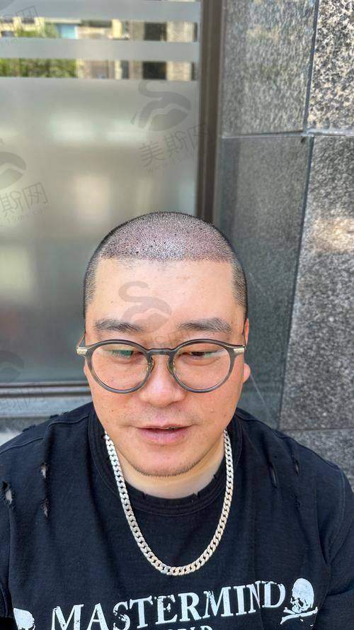 上海植发好的三等甲医院有哪些