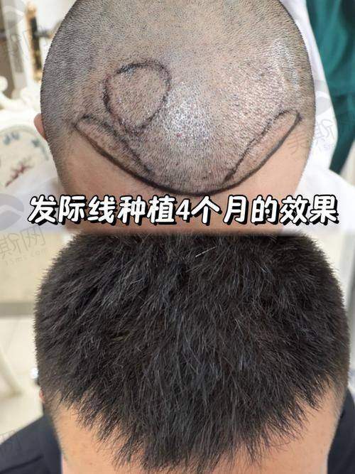 选择上海植发三等甲医院的关键选择点