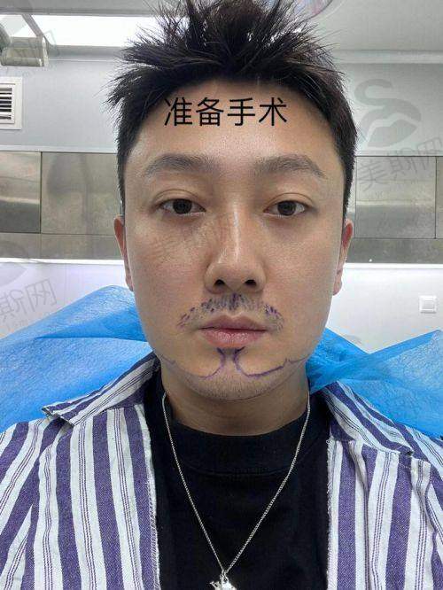 倍生植发医院不同技术价格差异原因