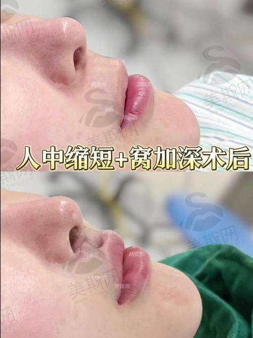 深圳素仁医疗整形美容门诊部江环环医生技术揭秘