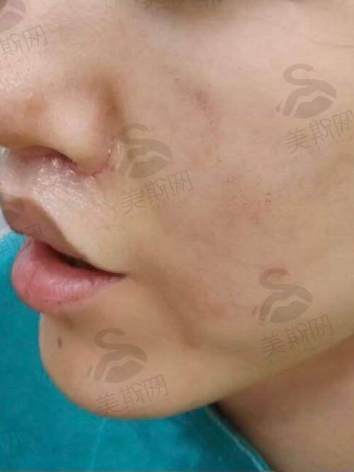 深圳福雅医疗整形美容门诊部胡俊杰医生技术揭秘