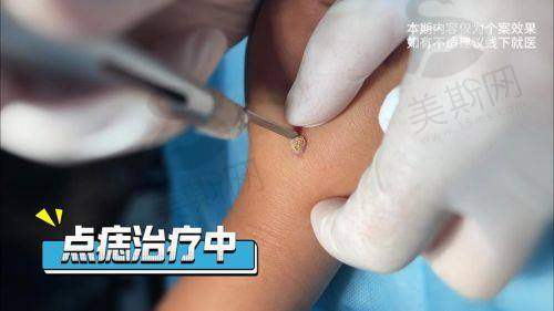 西安各正规医美机构切痣价格揭秘