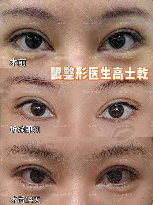 选择吕方中医生做双眼皮的术前术后避坑指南