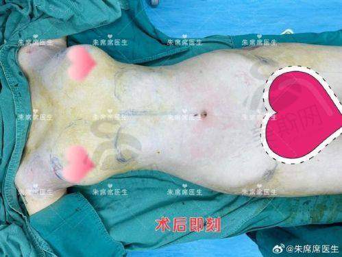 郑州脂肪填充项目真相