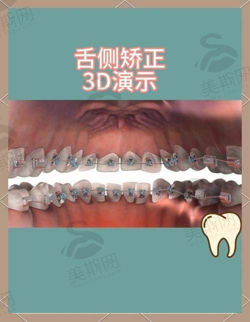 深圳格伦菲尔口腔牙齿矫正价格情况