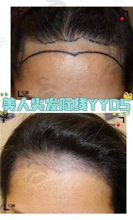杭州双眼皮手术的项目真相