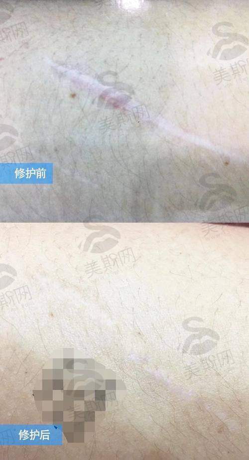 江门中 心医院植发