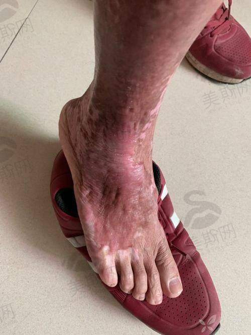 植皮相关医院其他信息补充