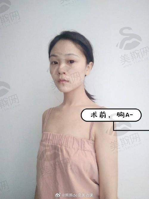 郑州脂肪填充关键选择点